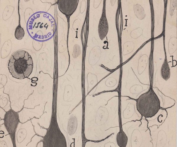 m1564. Axones dañados de neuronas piramidales en la corteza cerebral.